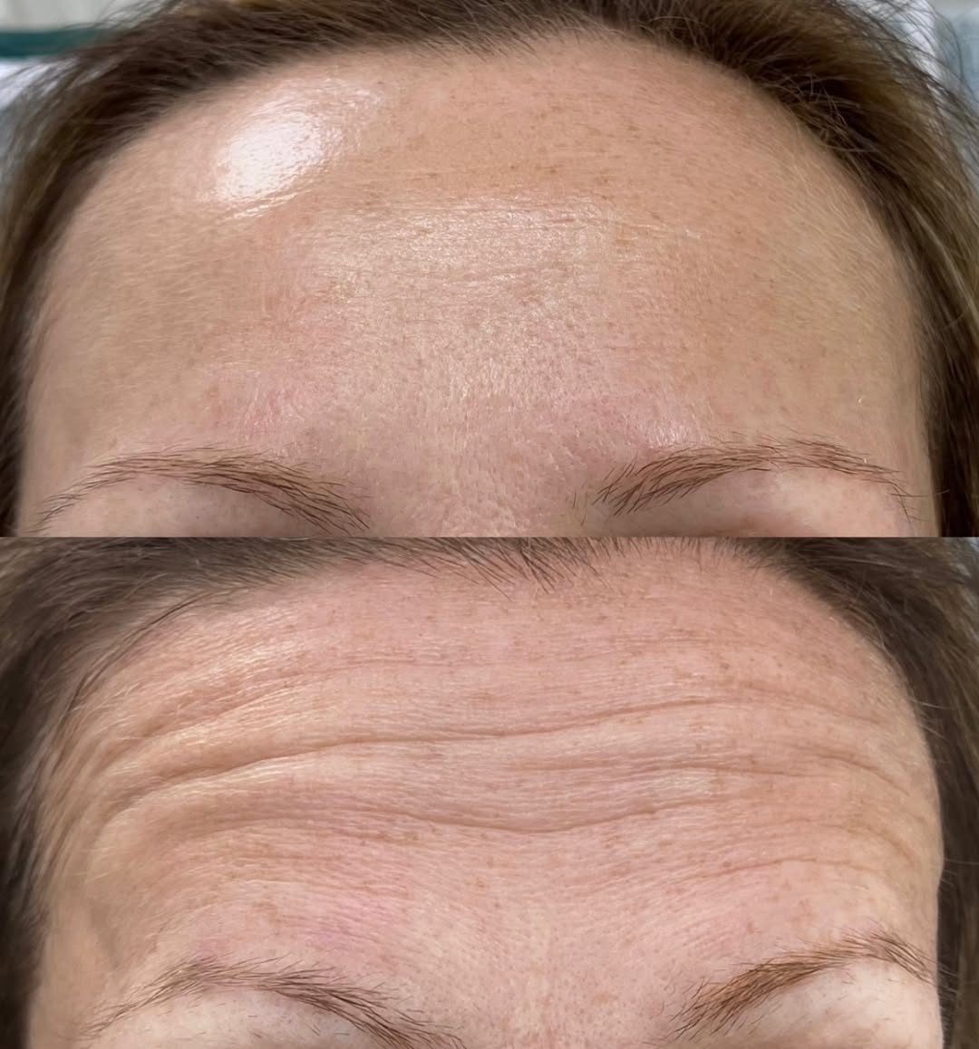 Niwelacja zmarszczek - Botoks