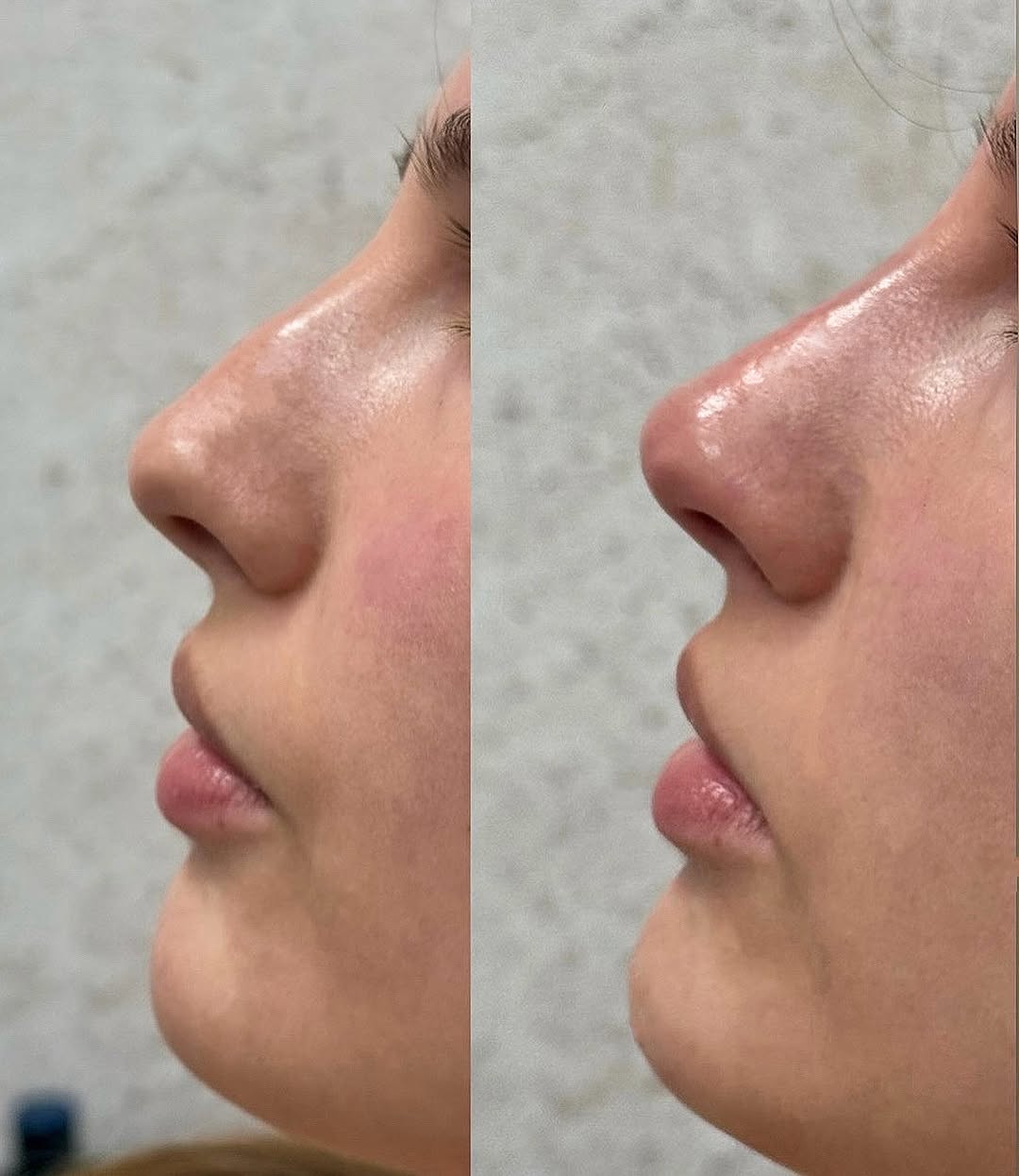 Efekt zabiegu: Korekta nosa