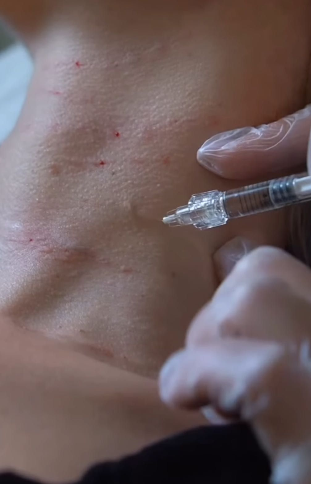 Mezoterapia mikroigłowa